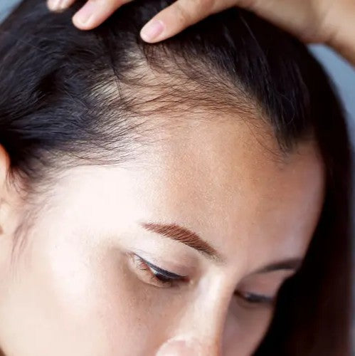 Androgenetic Alopecia (AGA): Causes, Stages and Natural Treatment Options