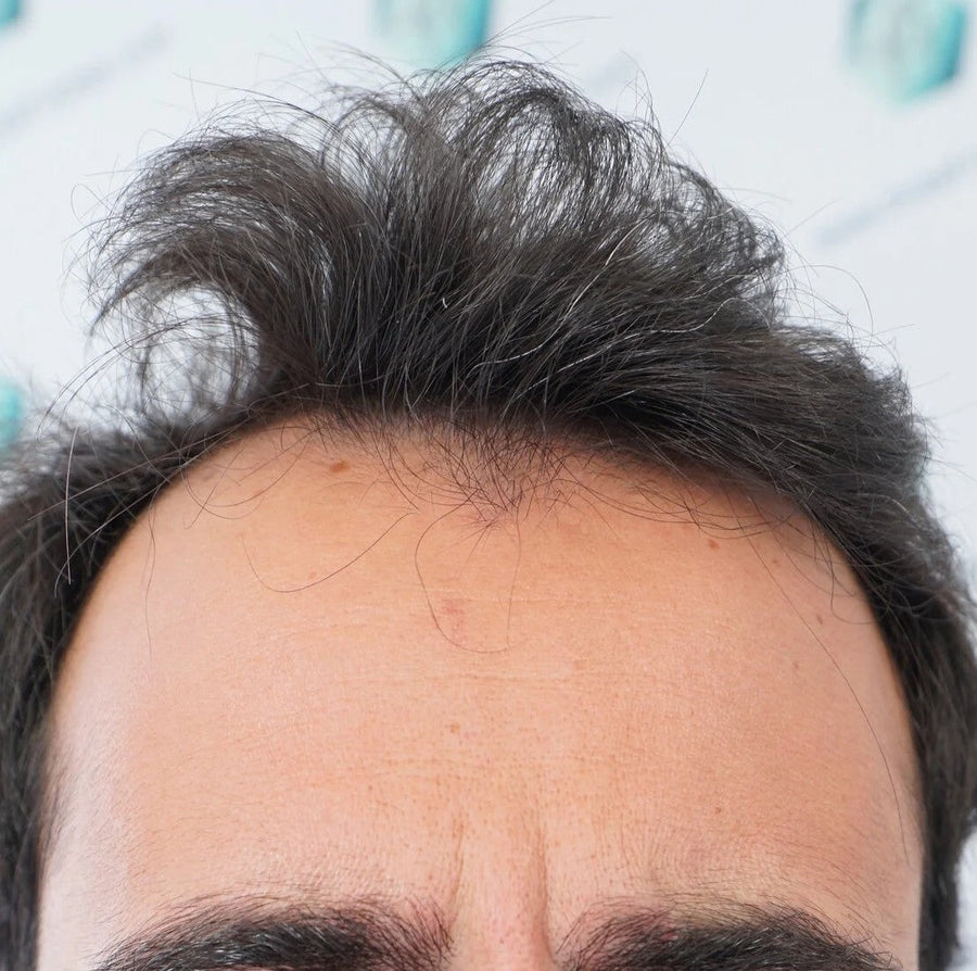 How to Stop a Receding Hairline Early