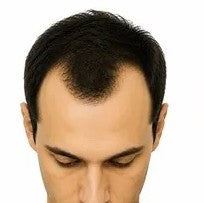 The Norwood Scale: The 7 Stages of Male Pattern Hair Loss