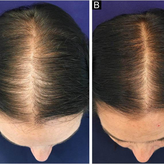 Female Pattern Hair Loss: Causes, Signs and Natural Treatment Options