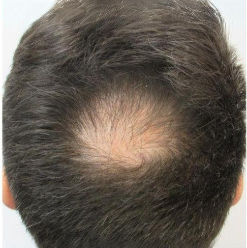 Is Androgenetic Alopecia Reversible?